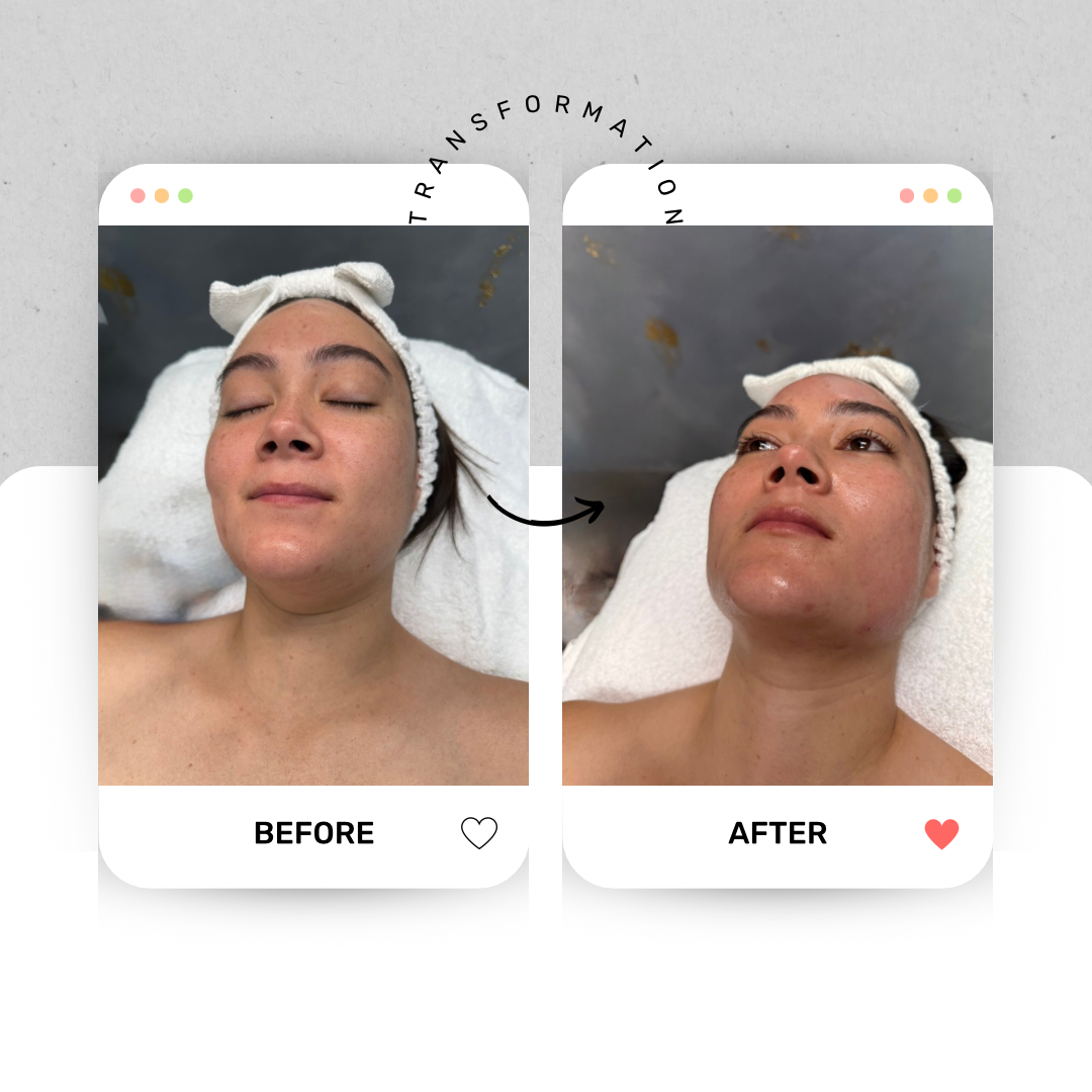 Microneedling with Hyaluronic Acid
