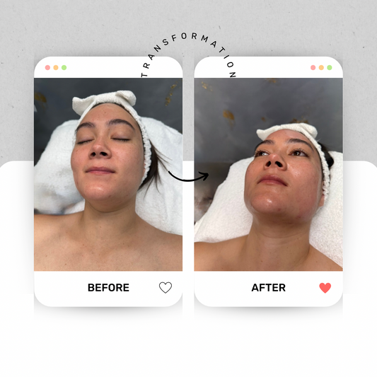 Microneedling with Hyaluronic Acid